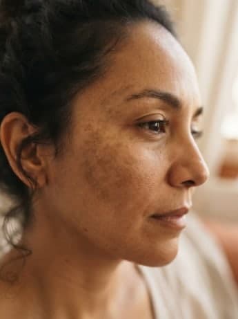Mujer de perfil con manchas en la mejilla